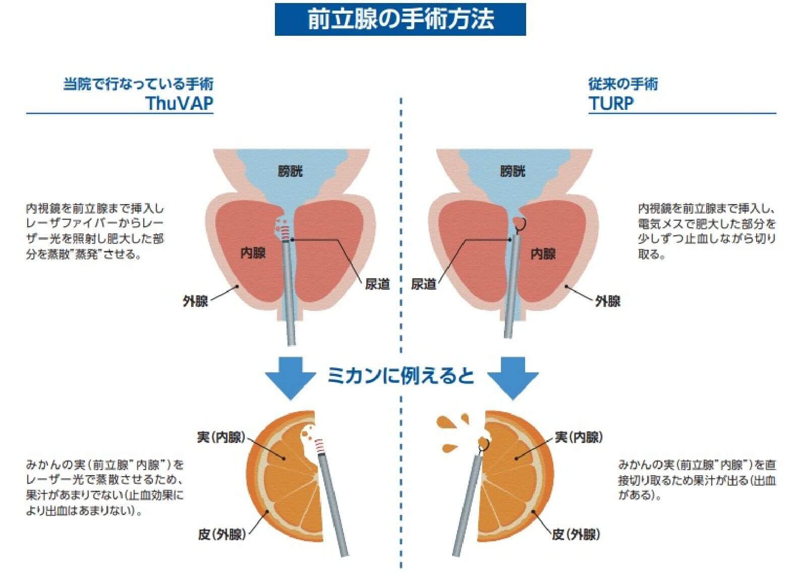 前立腺の手術方法
